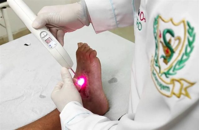 Laserterapia como Recurso Avançado no Tratamento de Feridas CLSP